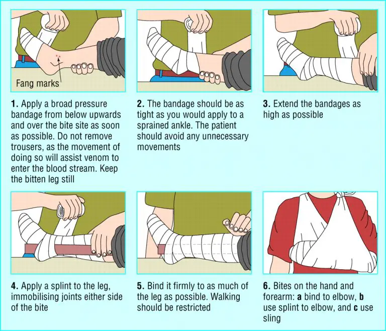 How To Treat Rattlesnake Bites?